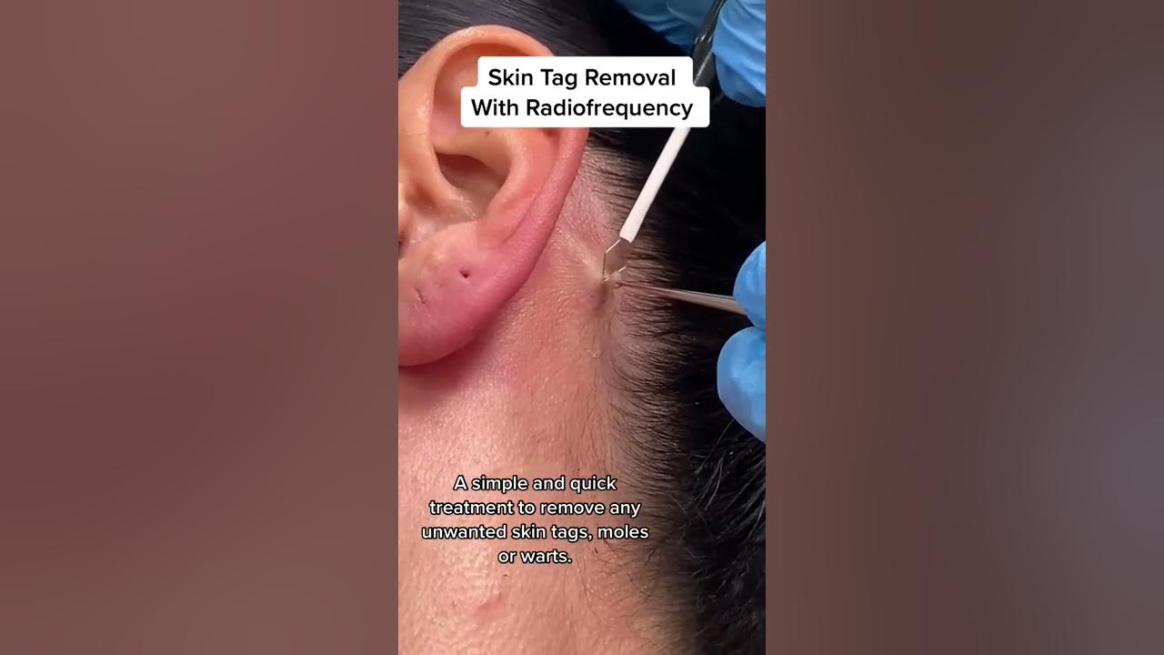 Skin Tag Removal With Radiofrequency | Quick & Safe Treatment DRMEDISPA