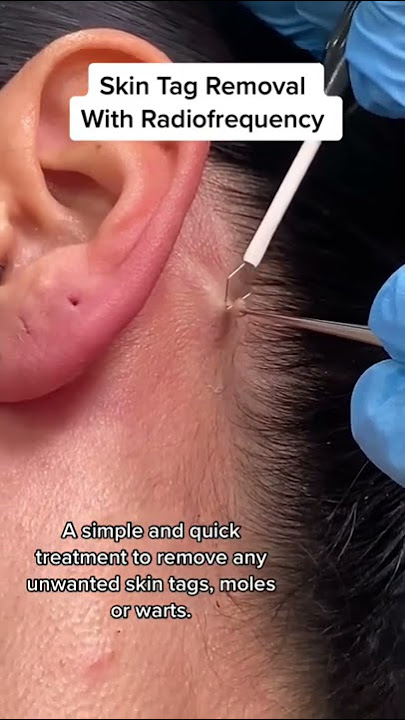 Skin Tag Removal With Radiofrequency | Quick & Safe Treatment DRMEDISPA