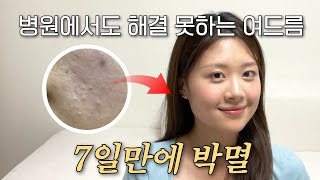 자꾸 번지고 흉터만 남던 여드름… 알고 보니 모낭염?｜관리법 &amp; 완치 찐후기 공개