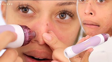 At-Home MicroDermabrasion: Does it work?!   | LEESA