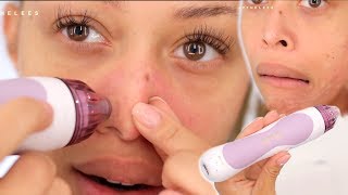 Hey guys!! i've been eyeing this pmd microdermabrasion device for
months! i finally gave in after wanting something to help clear my
skin, fade acne scars an...