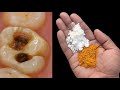 सिर्फ 2 मिनट में दांत दर्द ख़त्म करने का घरेलू इलाज|Home Remedy for Toothache,Dant dard ka ilaj