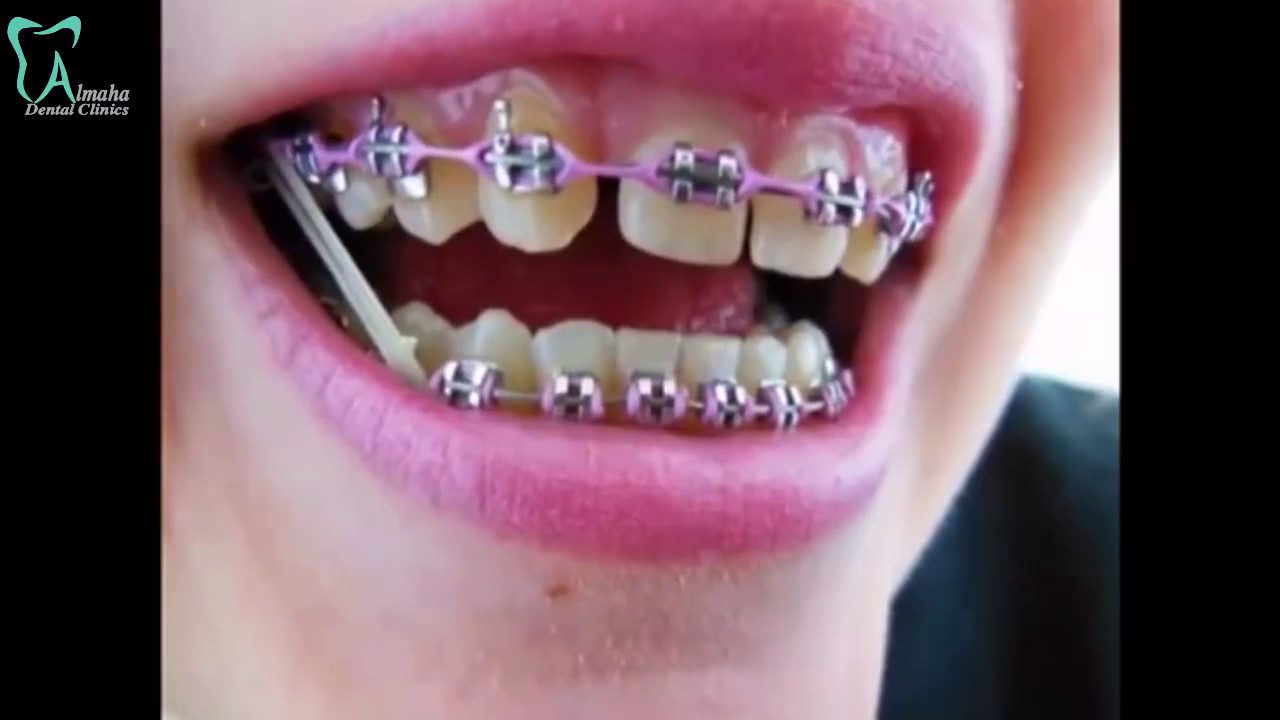 Orthodontic Case at Al WUKAIR/ Qatar/ Al Maha Dental Clinics. YouTube