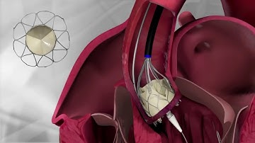 Portico Transcatheter Aortic Heart Valve