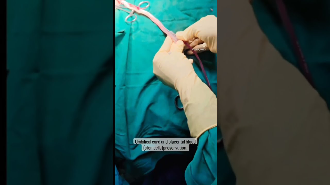 Easy Process Of Cord Blood Collection By Dr Sarala