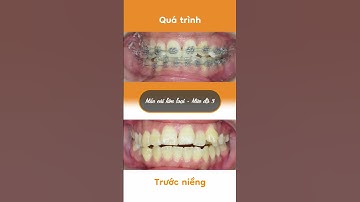 Hành trình LỘT XÁC nhờ niềng răng của Anh Tâm