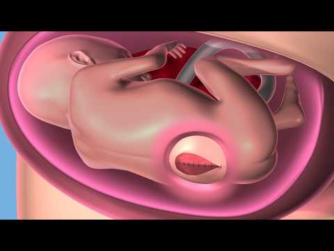 Myelomeningocele Repairs Launch the Era of Fetal Surgery at Cleveland Clinic