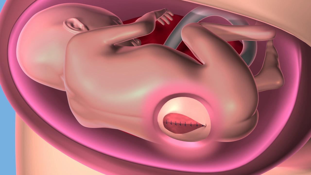 repairsomes Myelomeningocele Repairs Launch the Era of Fetal Surgery at Cleveland Clinic