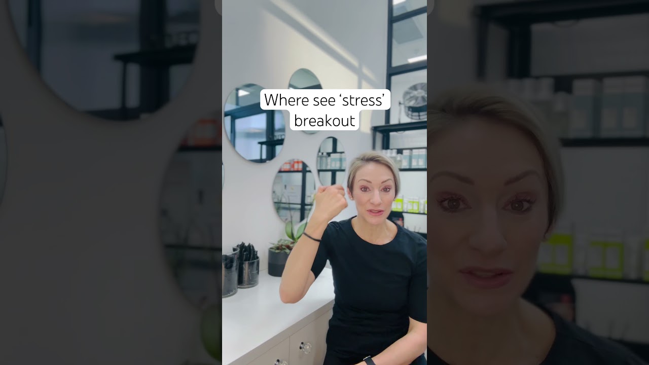 Where on the face could you see a ‘stress’ breakout? 