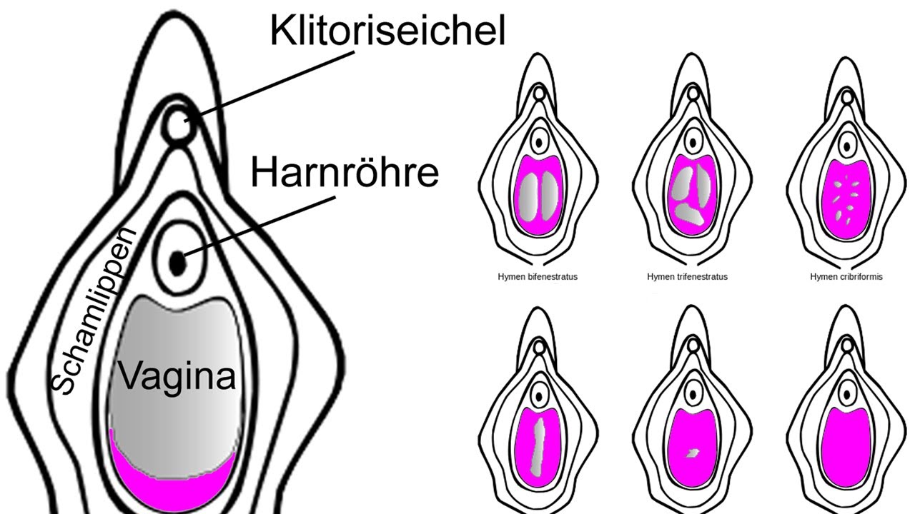 Hymen Jungfernhäutchen.