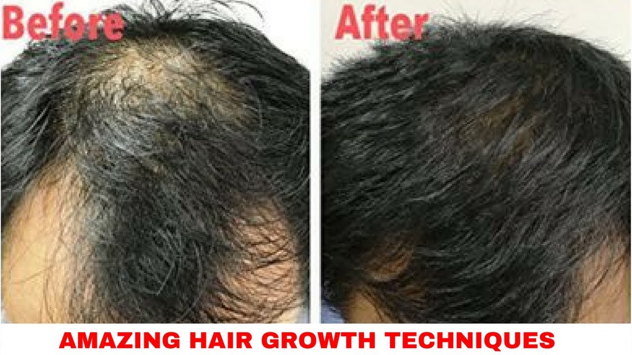 3 AMAZING Exercises & Techniques to Stop Hair Loss - YouTube