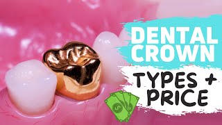 Dental Crowns Explained | WATCH BEFORE YOUR CROWN PROCEDURE!