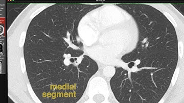 Lobar and Segmental Lung Anatomy on CT
