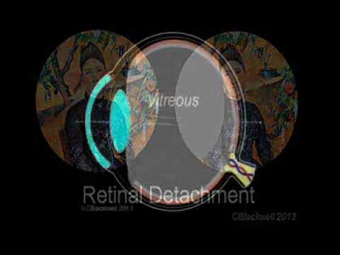 Retinal Detachment