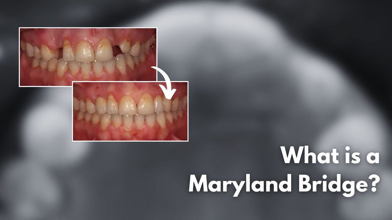 What is a Maryland Bridge?