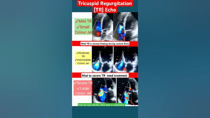 Mild, Moderate, Severe TR in Echo l इको टेस्ट l #echo #shorts