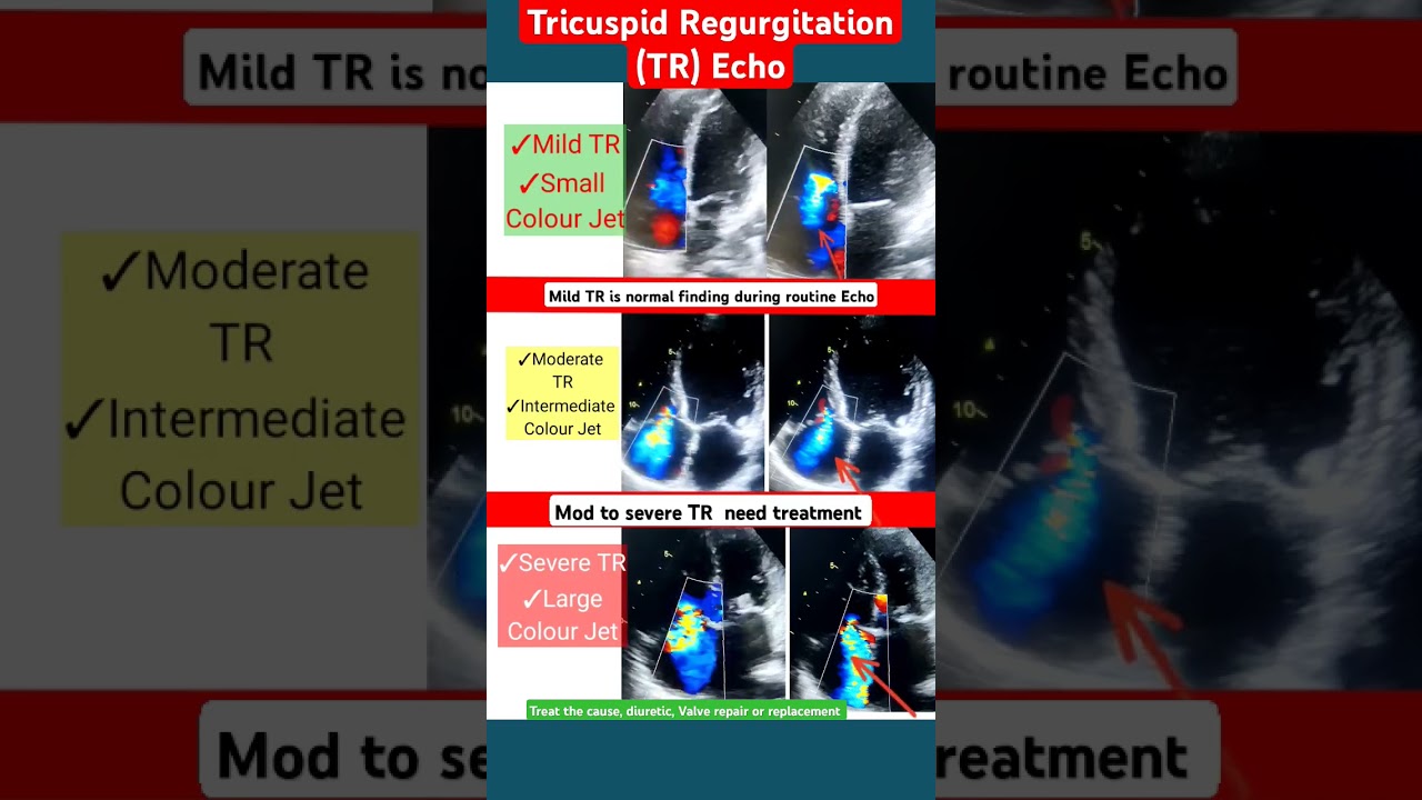 Mild, Moderate, Severe TR in Echo l इको टेस्ट l 