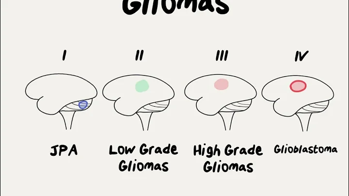 Doctor Explains Glioma Brain Tumor - DayDayNews