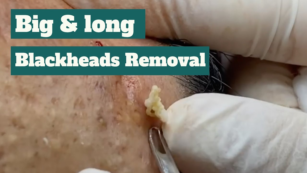 Big & long blackheads removal YouTube
