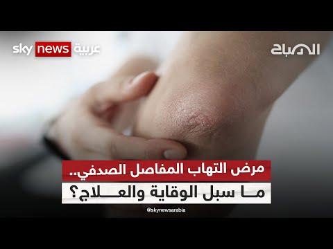 مرض التهاب المفاصل الصدفي ما سبل الوقاية والعلاج الصباح