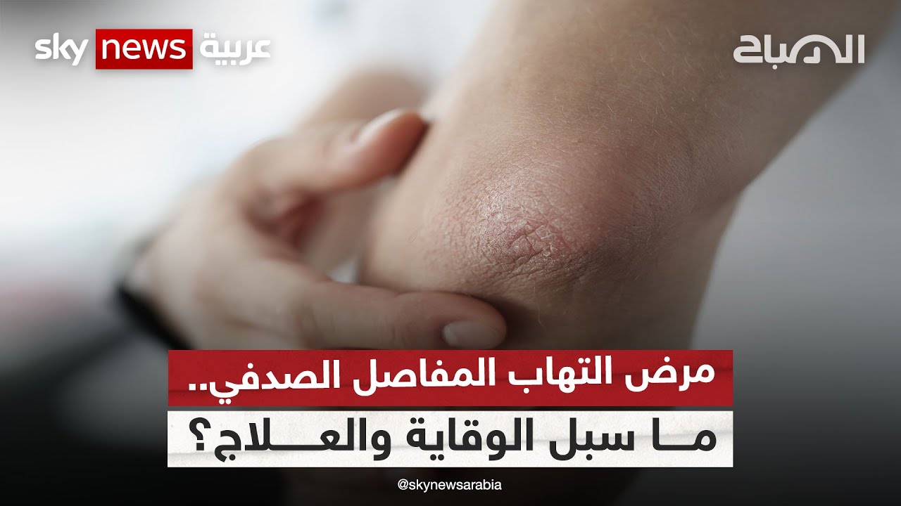 مرض التهاب المفاصل الصدفي.. ما سبل الوقاية والعلاج؟  | #الصباح