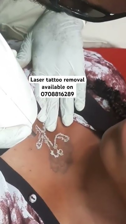 laser-tattoo-removal-in-kenya-tattooremoval-kenya-nairobi-youtube