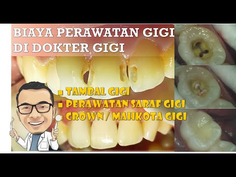 Video: Mahkota Gigi: Apa Itu, Bagaimana Ia Diletakkan, Adakah Sakit?