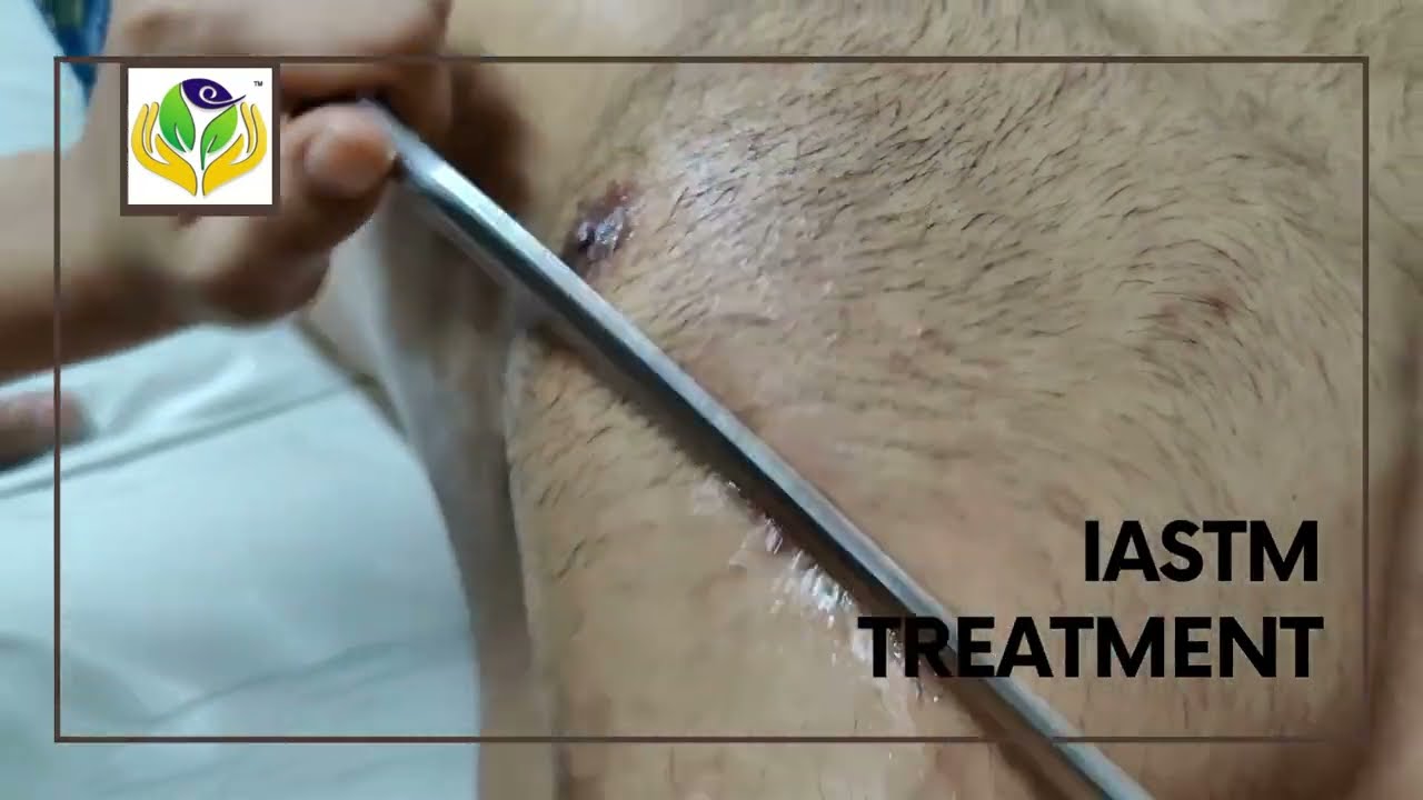 How Does IASTM Treatment for Body Recovery Work? | improved range of motion | pain relief