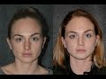 Rhinoplasty NYC 29 Year Old | Best Rhinoplasty Surgeon NYC #bestrhinoplasty