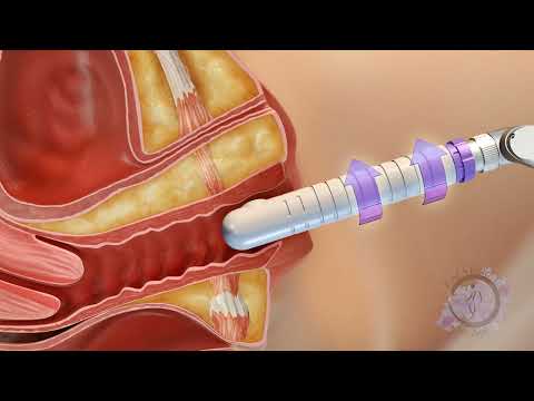 A animation of how the C02re Intima Vaginal Rejuvenation Works