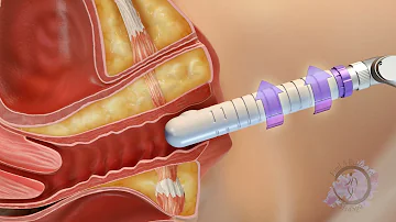 A animation of how the C02re Intima Vaginal Rejuvenation Works