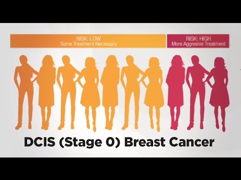 DCIS (Stage 0) Breast Cancer and the Oncotype DX DCIS Score