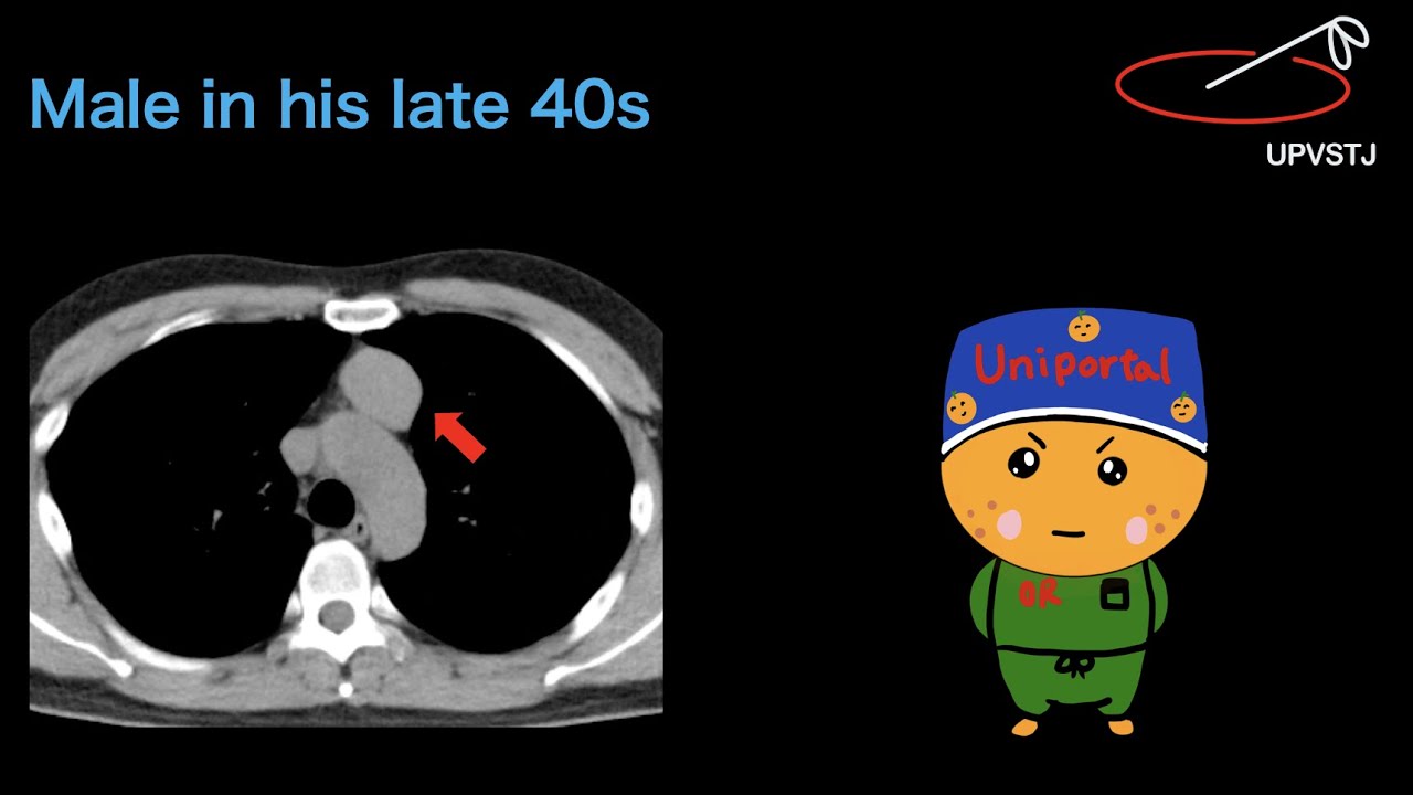 79】Subxipoid MT left hemithymectomy YouTube