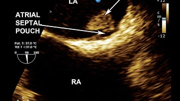 Left Atrial Septal Pouch associated with thrombus 2014