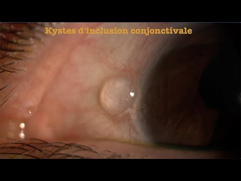 Vidéo: Kyste Conjonctival: Symptômes, Causes, Diagnostic Et Traitement