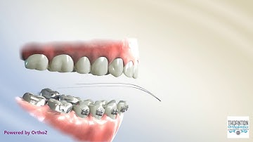 Curve of Spee Correction-Reverse Curve, Lower