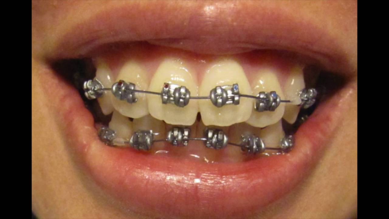 Quick Braces Progression YouTube