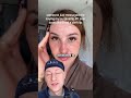Surgical Lip Lift SCARRING | Plastic Surgeon Reacts