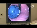 Endoscopic gastric balloon insertion for weight loss. All steps. By: Dr. Yerdel