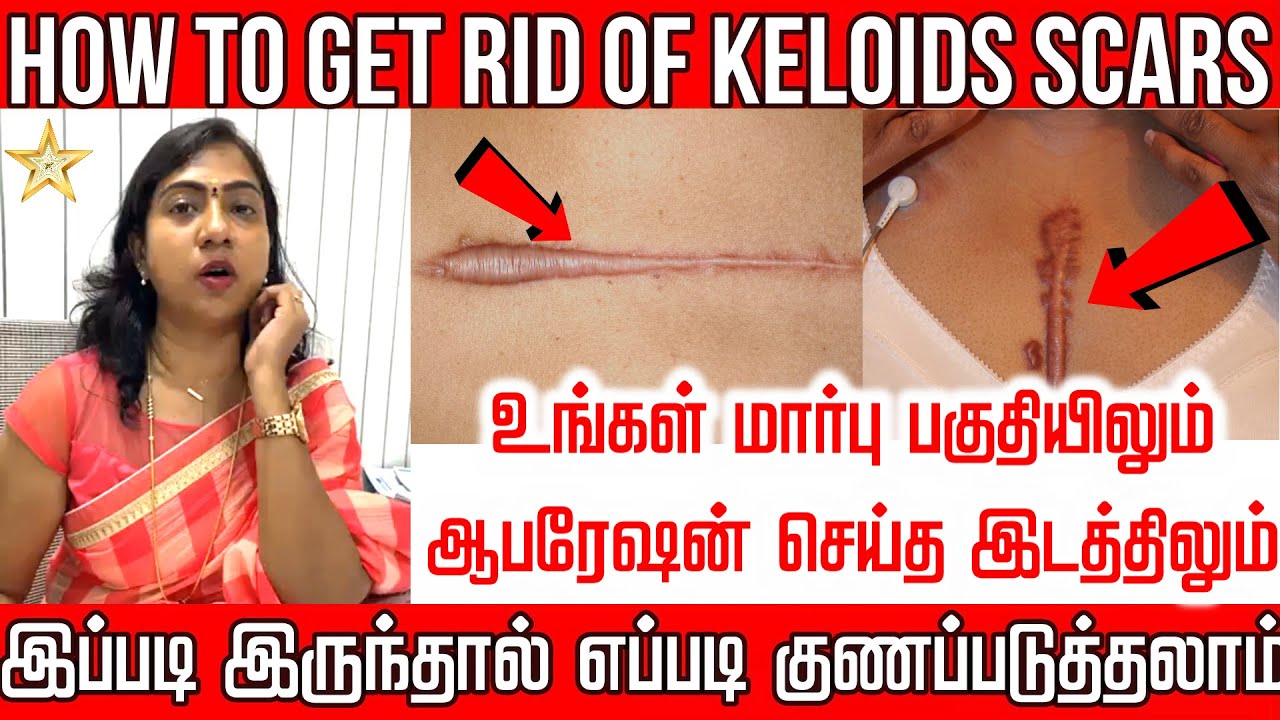 How To Get Rid Of Keloids Scars | மார்பு பகுதியிலும் ஆபரேஷன் செய்த