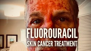 Fluorouracil Skin Treatment - Before, During, and After by The Adventure Travelers 288,130 views 3 years ago 6 minutes, 54 seconds