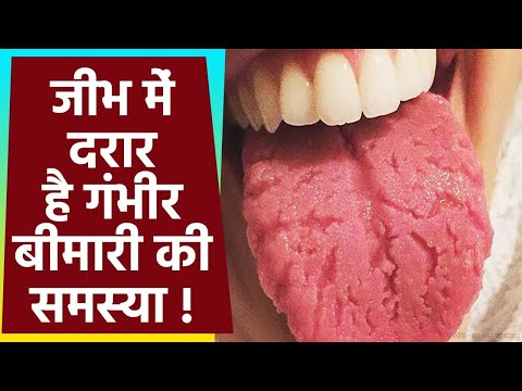 वीडियो: दरार की रेखाओं से कैसे छुटकारा पाएं?