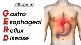 Know about Gastroesophageal Reflux Disease GERD ! full animation video | #acidreflux