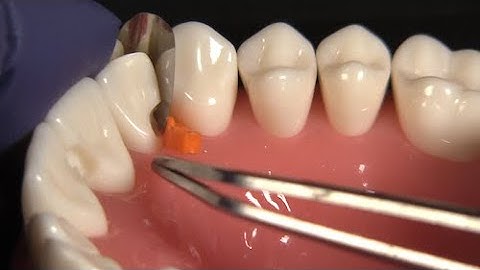 Tips for Using the NEW Fusion Anterior Matrix System for Deep Restorations with Dr. JD Corey