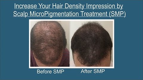 Increase Your Hair Density Impression by Scalp MicroPigmentation (SMP)Treatment. Contact:9700020802