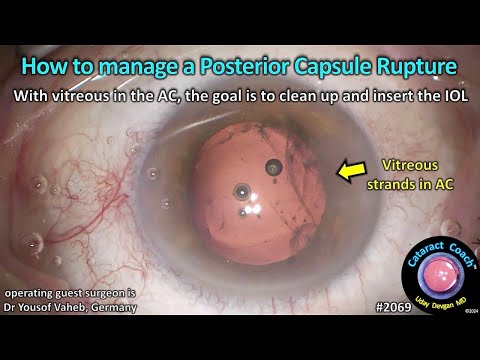 CataractCoach™ 2069: how to manage a posterior capsule rupture in cataract surgery