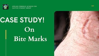 Case Study ! On Bite Marks (Part:1)