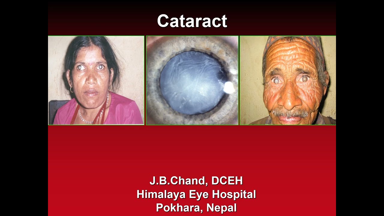 Cataract 