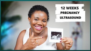 12 Weeks Pregnancy Update and Ultrasound | Surprise | Vlog