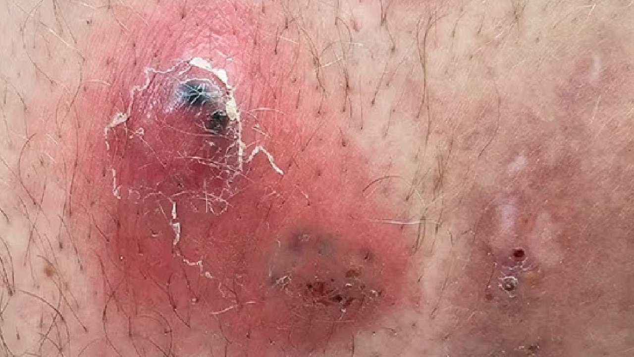 HOW TO GET RID OF INGROWN HAIRS QUICKLY